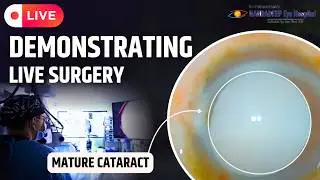 Mature Cataract Dr. Sourabh D Patwardhan 3D live Phaco surgery.