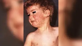 Public Officials Take Action to Battle Measles