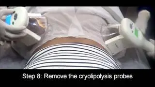 Cryolipolysis Treatment in Mumbai, India- Dr. Monica Jacob, Bodyz Wellness