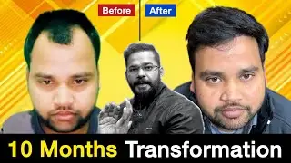 Natural Hair Transplant Result | सभी भारतीय हेयर ट्रांसप्लांट क्लीनिकों के लिए चुनौती: गलती ढूंढें