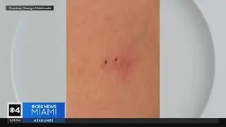 Man warns others after saying he was bitten by bats at SW Miami-Dade park