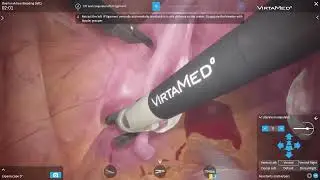 VirtaMed LaparoS&trade; - Ovarian Artery Bleeding Left