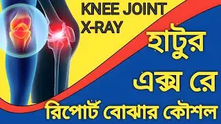 knee joint x ray report in Bengali |হাটুর এক্স রে রিপোর্ট বুঝার কৌশল