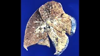 GENERAL PATHOLOGY 10 : pathological calcification DR SAMEH GHAZY