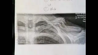 In this run I broke my collarbone 😖 short bike review