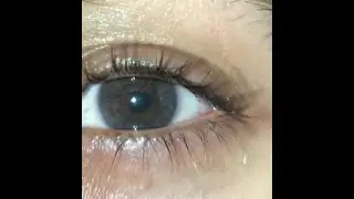 Grade 5 pre op laser eye color change - Irex Laser