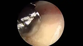 Beginning of CAM resection, Cody Harlan MD