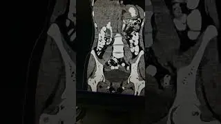 #ctscan #case #tb #intesting #intestine #case #radiology #radiologyresident #interestingfacts