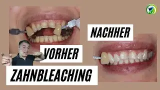 Vorher- nachher, Bleaching - Zahnaufhellung, Ablauf, Kosten, Erfahrung