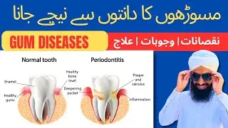 Free Home Remedies For Gum Recession | How to STOP Gum Recession Naturally | Dant Dard Ka Ilaj