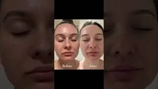 Laser Genesis Treatment Explained: Smooth Skin, Smaller Pores, and a Youthful Glow