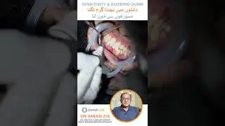 Teeth Scaling Treatment by Dr Imran Zia | Dental Guild | Urdu Hindi
