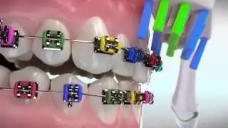 Easy Braces Brush