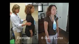 BrainPort Balance Patient After 8 Days Training