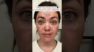The BEST way to fade melasma? Pair together The Spot Cream and The Spot Pill 💕 #musely #melasma