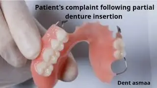 Patient's complaint following partial denture insertion شرح شكاوي المرضي بعد تركيب الطقم الجزئي