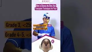 Which Hair Transplant Technique is Best for 5000 Grafts #shorts  #hairtransplant