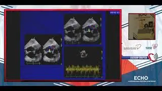 Case Presentation: Percutaneous Balloon Mitral Valvuloplasty for Mitral Stenosis
