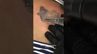 Tattoo removing see the magic …..❤️
