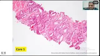 How to interpret TURP chips | Gleasons scoring | Prostate biopsy interpretation |Prostate pathology