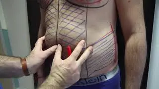 Vaser Liposelection-Vaser Liposuction-Liposakşın