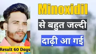 Beard growth tips in Hindi | Patchy beard growth | Grow beard naturally at home | We Know Hair