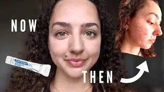 Differin Gel Review