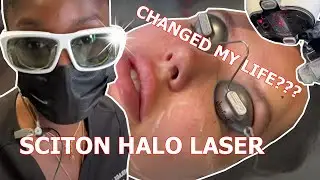 SCITON HALO LASER CHANGED MY LIFE BY IMPROVING MY ACNE SCARS AND SKIN TEXTURE | Dr. Jason Emer