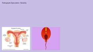 Retrograde ejaculation Explained Causes, Symptoms and Treatment, All Insights