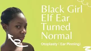 Black Girl Elf Ear Turned Normal (OTOPLASTY/ EAR PINNING SERIES)