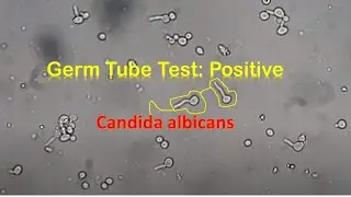 Germ Tube Test Positive Candida