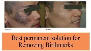 Types of Birthmarks & Its Treatment! | The Esthetic Clinics, India