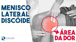 MENISCO LATERAL DISC&Oacute;IDE: O que &eacute;, diagn&oacute;stico e tratamento
