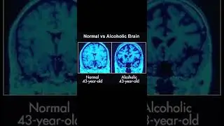 43 yrs  normal brain VS alcoholic person brain #health #healthandfitness #awerness#education