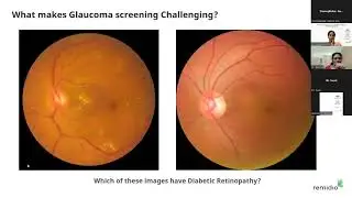 Webinar | Revolutionizing Glaucoma Care: Unleashing the Power of Offline Smartphone AI.