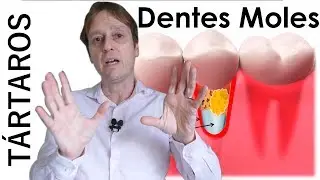 Dentes Moles e Tártaros nos Dentes  - Os Tártaros Podem Levar os Dentes a Ficarem Moles?