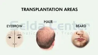 Hair Transplant Informative Video | Selda Center