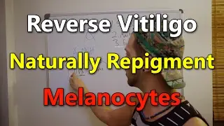 VITILIGO: Increase Natural Pigmentation - Reverse Vitiligo & Increase alpha-MSH