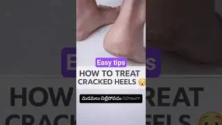 How to Prevent Cracked Heels Naturally Simple Foot Care Tips#shorts#crackedheeltreatment#arunachalam