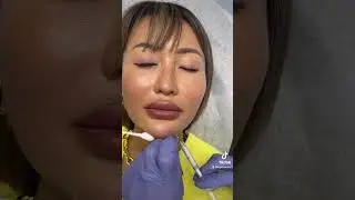 Check this out! Amazing Chin Filler treatment - Ageless MD