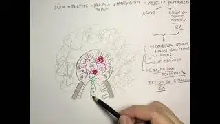 Doenças periapicais: entendendo os mecanismos - vídeo 11