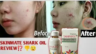 SKINMATE SHARK OIL REVIEW!!!🧴| BAKIT LUMALA ANG PIMPLE KO?! 1-7 days review