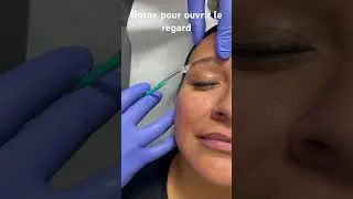 Botox pour ouvrir le regard - Dr Raspaldo #medecineesthetique #botox
