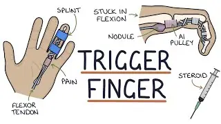Trigger Finger | stenosing tenosynovitis | Drk