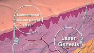 Laser Genesis by Dr. Yuriy Yagudin.m4v