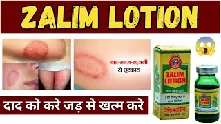 Zalim Lotion use in hindi 🔥😱 | Zalim Lotion fungal Treatment |  Fungal infection | Antiseptic