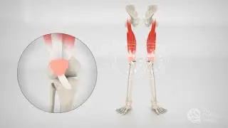 Treat Patellofemoral Pain Syndrome using Vancouver Orthotics by Dr  Michael Horowitz | 604-737-3668