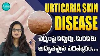 Tips to get rid of Urticaria || Urticaria-Causes & Symptoms || Treatment for Urticaria #hives