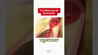 L'infarctus du myocarde #education #m&eacute;decine #foryou