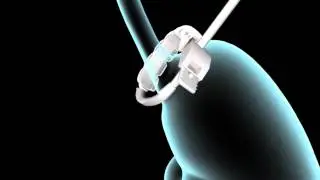 LAPBAND